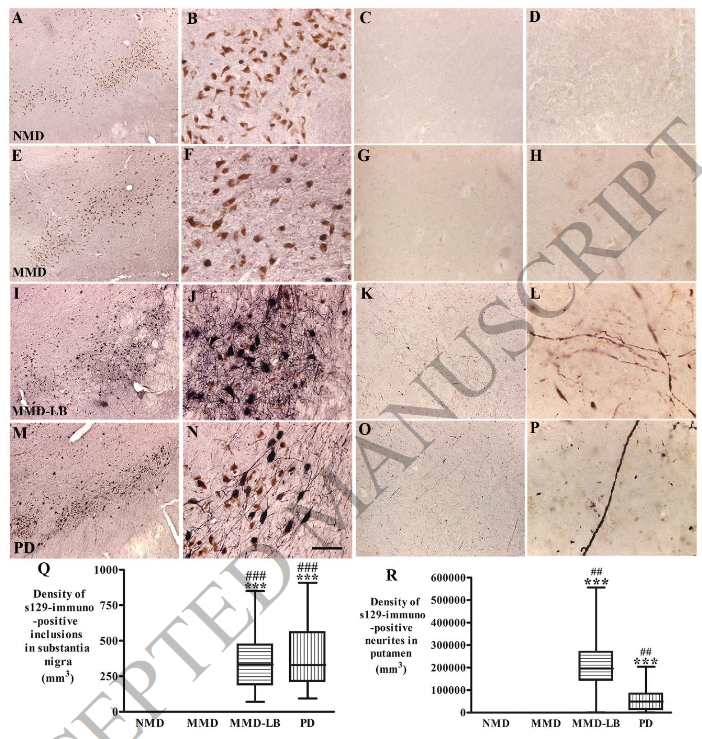 ScienceofPD's tweet photo. Alpha synuclein is sooo 20th century

New paper from Kordower &amp; colleagues "suggests that the initiation of nigrostriatal dopaminergic neurodegeneration occurs independently of alpha-synuclein aggregation &amp; can be tau mediated"; Implications 4 #Parkinsons?
https://t.co/VetiksSHyv https://t.co/lAQzEOQMaU