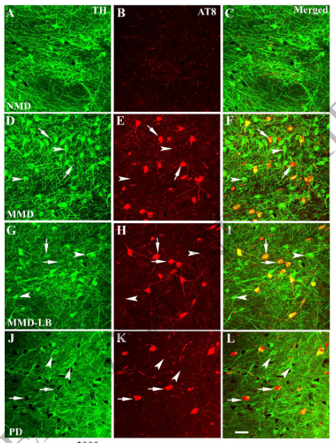 ScienceofPD's tweet photo. Alpha synuclein is sooo 20th century

New paper from Kordower &amp; colleagues "suggests that the initiation of nigrostriatal dopaminergic neurodegeneration occurs independently of alpha-synuclein aggregation &amp; can be tau mediated"; Implications 4 #Parkinsons?
https://t.co/VetiksSHyv https://t.co/lAQzEOQMaU