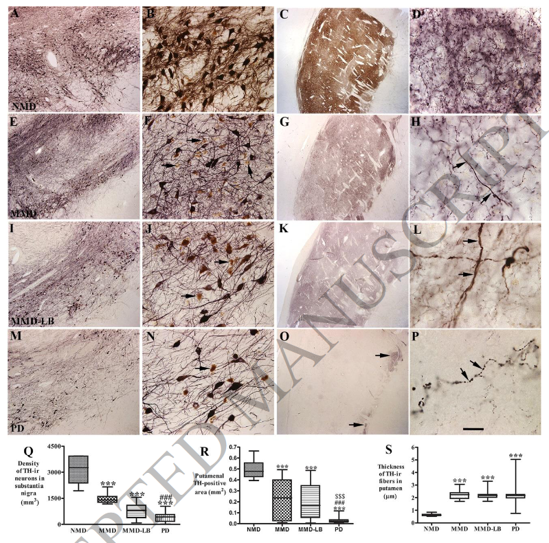 ScienceofPD's tweet photo. Alpha synuclein is sooo 20th century

New paper from Kordower &amp; colleagues "suggests that the initiation of nigrostriatal dopaminergic neurodegeneration occurs independently of alpha-synuclein aggregation &amp; can be tau mediated"; Implications 4 #Parkinsons?
https://t.co/VetiksSHyv https://t.co/lAQzEOQMaU