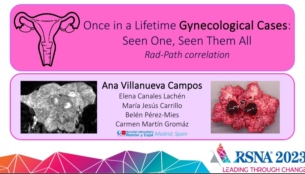 📣 Grab a coffee and check out our poster #RSNA2023 ♀️ 'Once in a lifetime gynecological cases: seen one, seen them all. Rad-path correlation' @CasesCookyJar @CasosCooky @residentesSERAM @RSNATrainees @SEAP_IAP @AIRP_Radiology