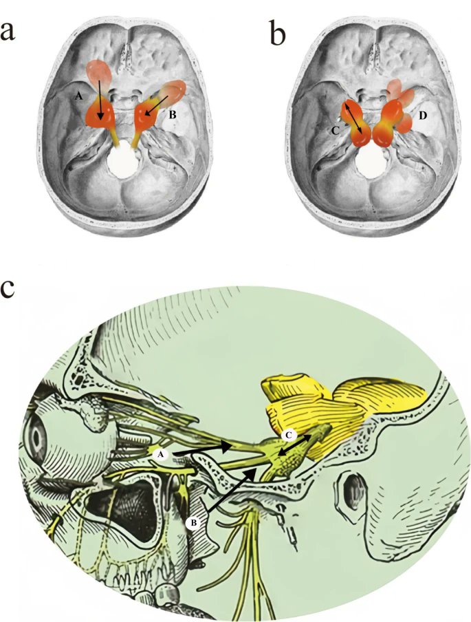 ActaNeuro's tweet image. #OnlineFirst: Operative management of trigeminal schwannomas: based on a modified classification in a study of 93 cases

Check out the full article at: 
link.springer.com/article/10.100…

#neurosurgery #trigeminal #schwannoma #classification