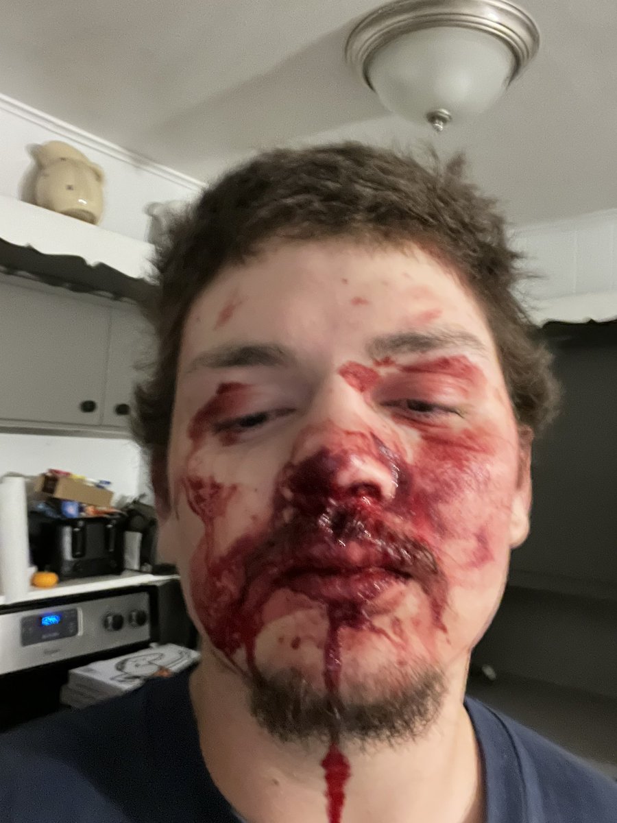 RySynn's tweet photo. got jumped last night https://t.co/5ICAVTztX2