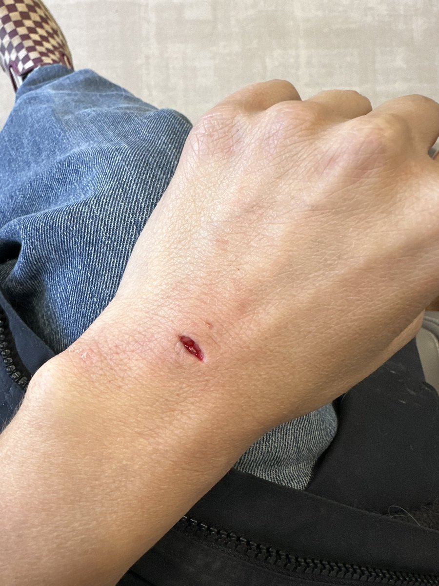 itsjust_jaaaane's tweet photo. How was my thanksgiving? I got bit by a dog…in the hand…and now my hand doesn’t work. Kinda put a monkey wrench in my plans for the next few months but it’ll buff or it won’t 🥲 https://t.co/vm3IbKJFsV