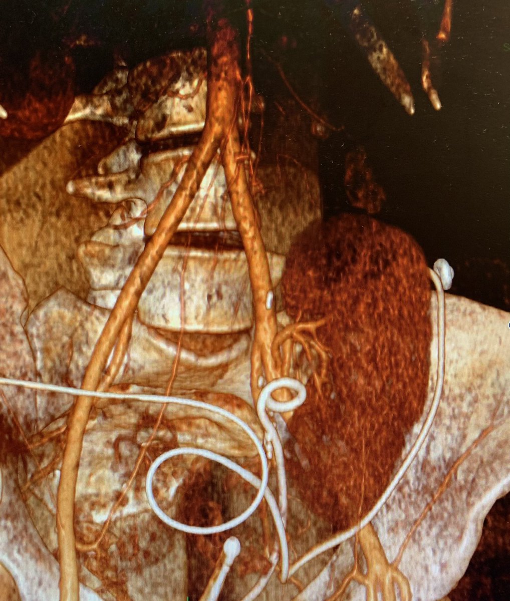 Full robotic (or robotic+open) autotransplantation is a great technique to treat extended iatrogenic ureteral avulsion. This week’s case with a tricky reconstruction of 2 small arteries. (With patient’s permission) . Favorite approach > ileal ureter according to @MejeanArnaud .