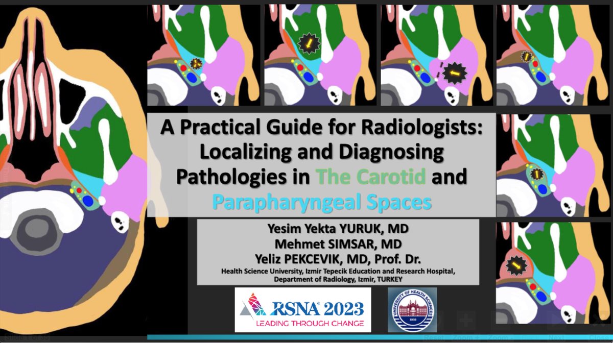 Yeliz Pekçevik, MD (@ypekcevik) on Twitter photo Check out our poster at #RSNA23
'A Practical Guide for Radiologist: Localizing and Diagnosing Pathologies in The Carotid and Parapharyngeal Spaces' <a href="/yesimyektayuruk/">mdyesimyekta</a>
#WeAreRadiology #HNRad #RSNA2023 <a href="/RSNA/">RSNA</a> <a href="/RSNATrainees/">RSNATrainees</a> <a href="/sbuedutr/">Sağlık Bilimleri Üniversitesi</a> Check out our poster at #RSNA23
'A Practical Guide for Radiologist: Localizing and Diagnosing Pathologies in The Carotid and Parapharyngeal Spaces' <a href="/yesimyektayuruk/">mdyesimyekta</a>
#WeAreRadiology #HNRad #RSNA2023 <a href="/RSNA/">RSNA</a> <a href="/RSNATrainees/">RSNATrainees</a> <a href="/sbuedutr/">Sağlık Bilimleri Üniversitesi</a>