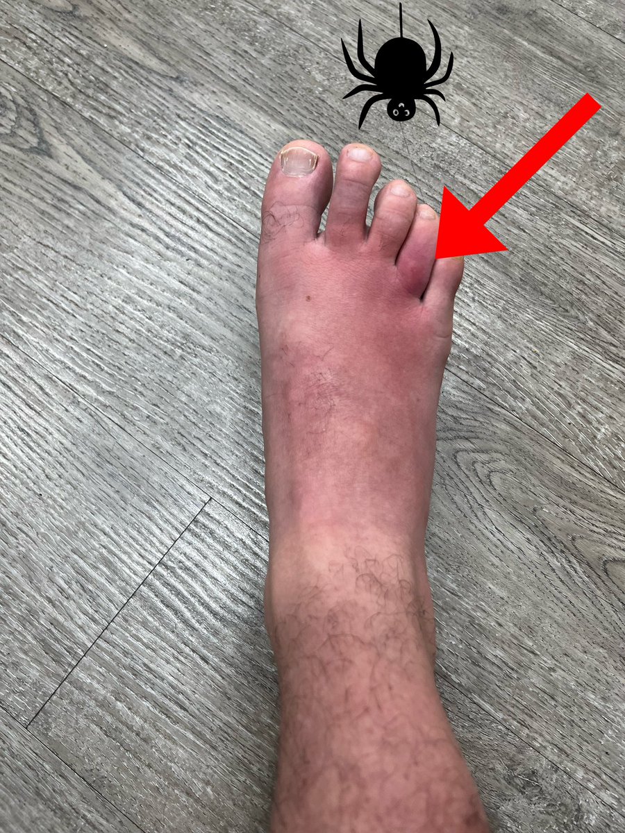 For my foot fetish friends!

It’s so swollen and sore! Who wants to kiss it a suck out the poison?