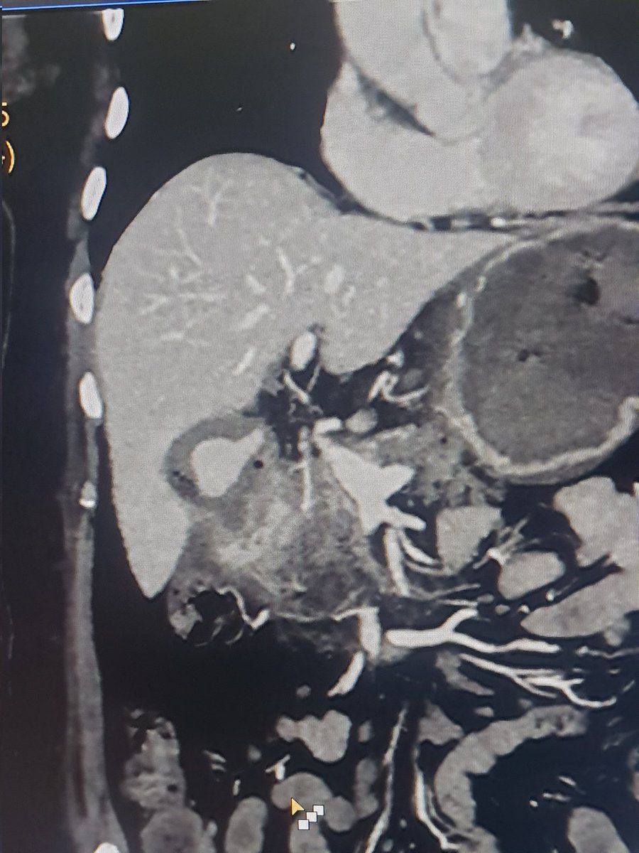 Dr Saurabh kumar Interventional radiologist tweet media