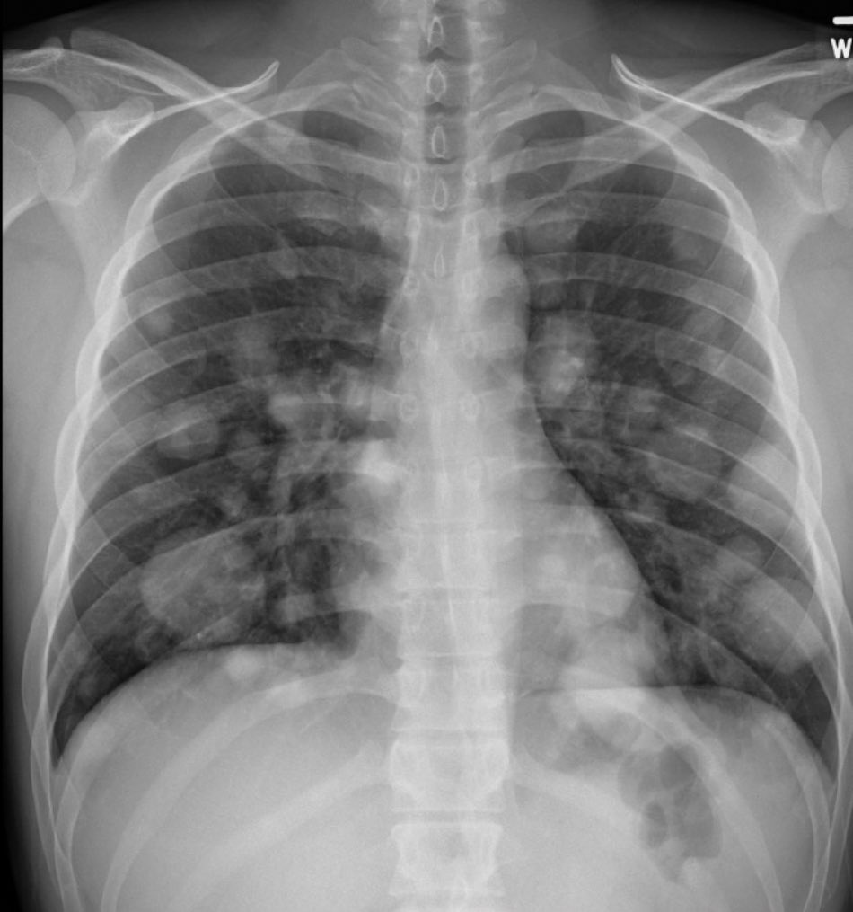 Here’s an important Chest X-Ray of a man in his 20’s who presented to the ER with cough for 1 month 

What’s the diagnosis?