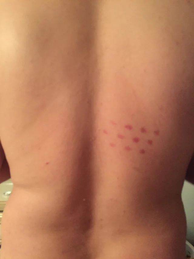 StarCptnDread's tweet photo. Time for a deep dive on #Redgridmarks #uapVictims
Radiation burns? Some sort of mechanical 'imprint'?
Have any information about these issues/marks???
Experienced this?
If this is part of a #UAPAgenda, what are they doing??
#uap #ufo #uapx #ufox #uaps #ufos #exopoliticsguide https://t.co/lfumECwZPB