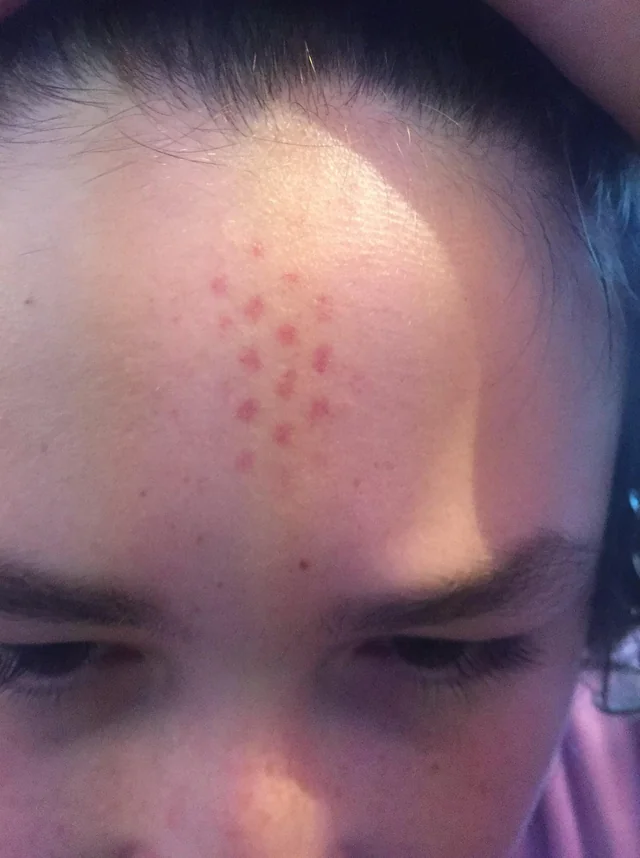 StarCptnDread's tweet photo. Time for a deep dive on #Redgridmarks #uapVictims
Radiation burns? Some sort of mechanical 'imprint'?
Have any information about these issues/marks???
Experienced this?
If this is part of a #UAPAgenda, what are they doing??
#uap #ufo #uapx #ufox #uaps #ufos #exopoliticsguide https://t.co/lfumECwZPB