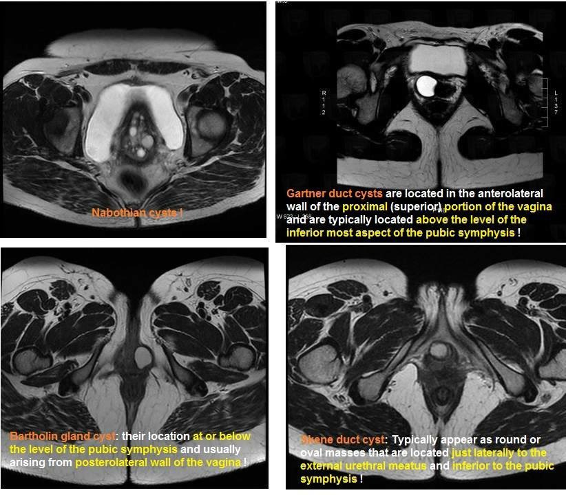 Pelvic cysts commonly encountered in daily practice 👇🏻👇🏻 Source - Unknown #FOAMrad @FOAMradOrg @Radiology_Vibes @DrYevSam_Rad