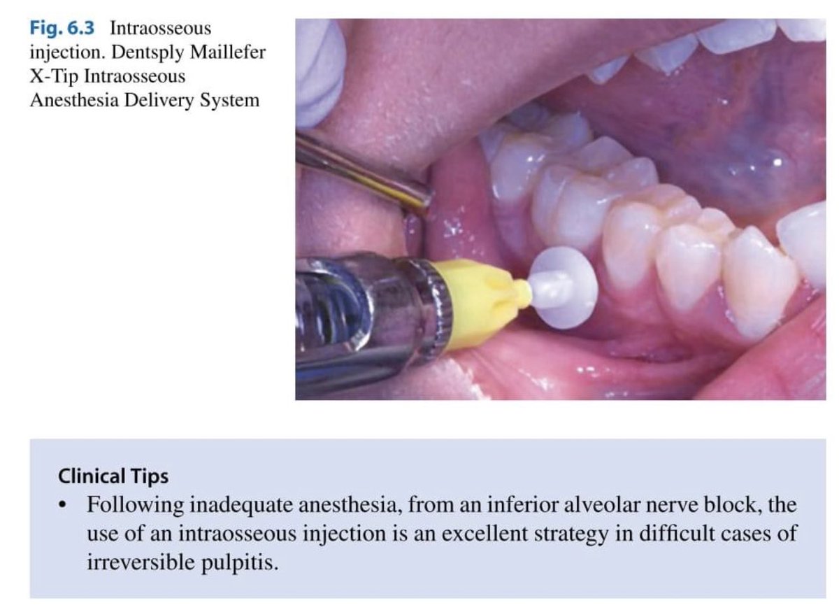 💠 | Intraosseous injection 💉