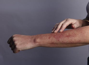 StayCured's tweet photo. Similarities, Differences, and the Link Between Eczema and Lymphoma  https://t.co/S6ln1ataNm  #Eczema #Lymphoma #fatigue #itchyskin #abdominalpain #StayCured https://t.co/CyC4oj871c