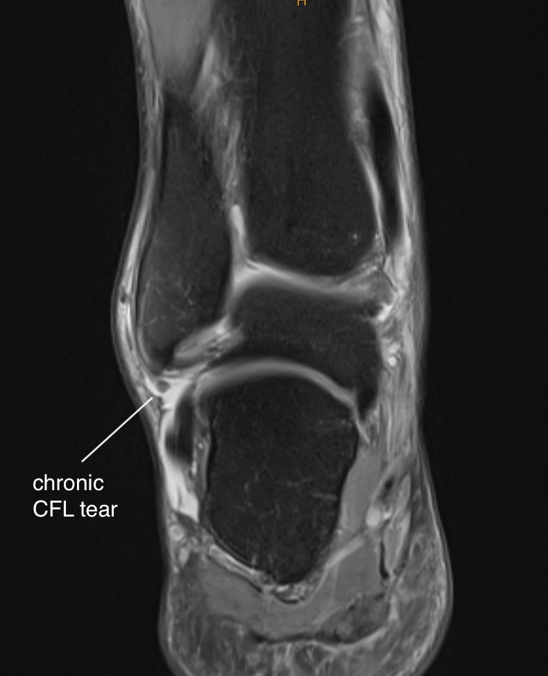 Companion MRI pics - chronic ATFL and CFL deficiency