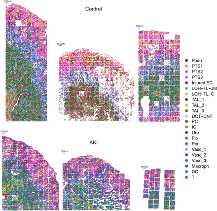 AlbertVilella's tweet photo. In #SpatialBiology news, a preprint on CKD using seqFISH. A little explainer below on Chronic Kidney Disease. https://t.co/P2f07WlAPt https://t.co/SGbvjkmpmK