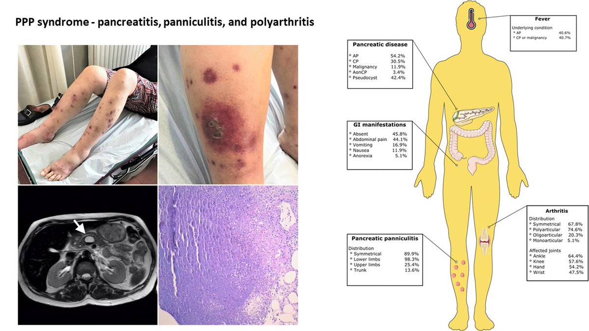 😉👨‍🎓'Repetitio mater doctrinae' PPP syndrome - pancreatitis, panniculitis, and polyarthritis Read more👉rdcu.be/dr6nF by @ABetrains and colleagues