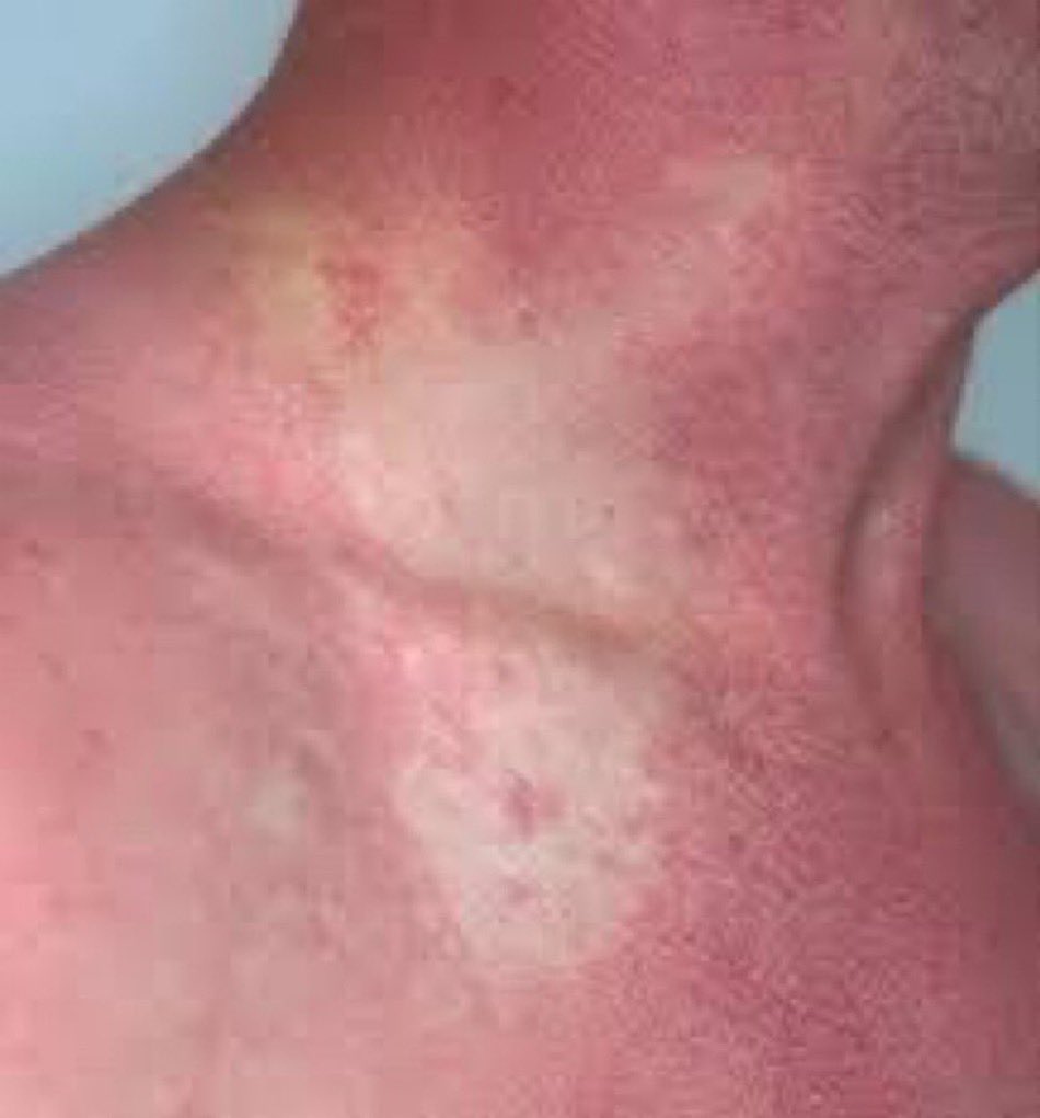 BrownJHM's tweet photo. A patient presented with generalized itching and rash for 2 days after eating canned mackerel. Additional symptoms included fever, abdominal pain, painful and swollen hands, and swollen eyes. What is the likely diagnosis? (Image: Dermatology Online Journal) #MedX https://t.co/c9eQJaB7gE