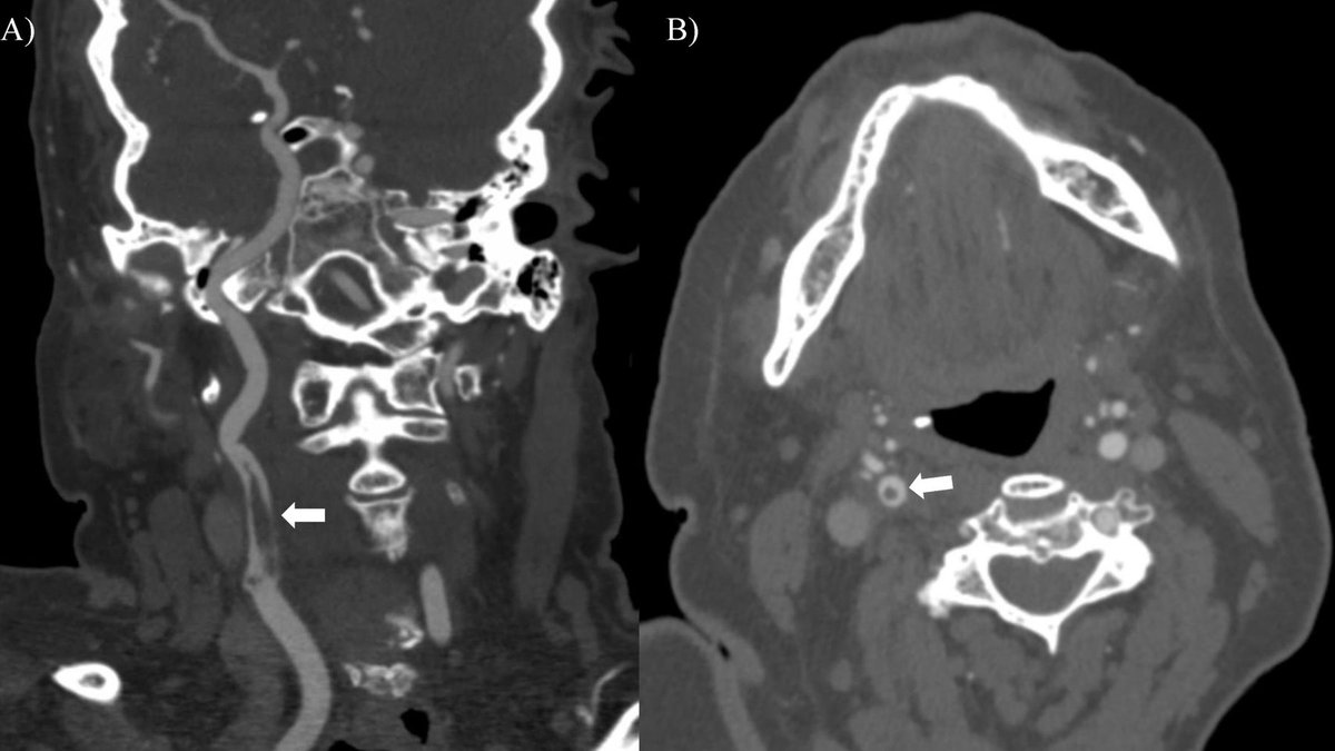 JNIS_BMJ's tweet photo. @D_SchartzMD, @SajalAkkipeddi demonstrate that thrombus volume of >= 90mm3 for free-floating thrombi will unlikely resolve with medical management (MM). 17% (7/41) failed MM in this cohort. Longer and bigger clots predict MM failure. Link: https://t.co/Ba2ChpxG7P https://t.co/XUmvQ4NSuk