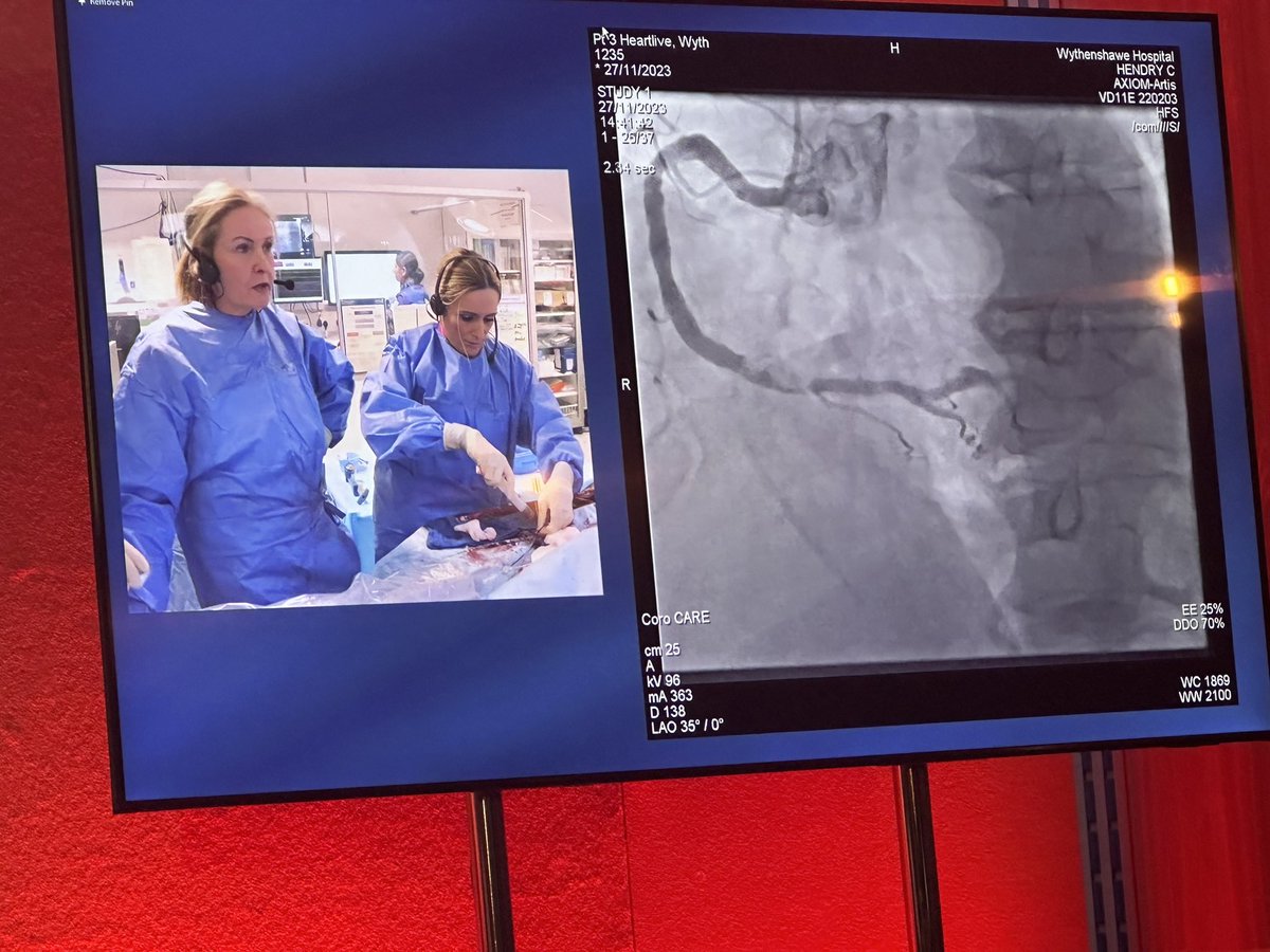 Mamas A. Mamas (@mmamas1973) on Twitter photo More live cases with @CaraCarahendry and joanne shannon doing a calcific rca and <a href="/StuartWatkins9/">Stuart Watkins</a> and <a href="/ford1102/">Farzin Ordoubadi</a> with an ostial calcific right at #HeartLive <a href="/DrPeterOKane/">Dr Peter O'Kane</a> <a href="/FerrahChoudhary/">Ferrah Choudhary</a> <a href="/alaide_chief/">chief</a> <a href="/WomenAs1/">Women As One</a> <a href="/Drroxmehran/">Dr Roxana Mehran</a> <a href="/ShrillaB/">Dr Shrilla Banerjee MD FRCP 💙</a> <a href="/KardiologieHH/">Erik Rafflenbeul</a> <a href="/JSillerMatula/">Jolanta SillerMatula, MD PhD</a> <a href="/aayshacader/">Aaysha Cader</a> More live cases with @CaraCarahendry and joanne shannon doing a calcific rca and <a href="/StuartWatkins9/">Stuart Watkins</a> and <a href="/ford1102/">Farzin Ordoubadi</a> with an ostial calcific right at #HeartLive <a href="/DrPeterOKane/">Dr Peter O'Kane</a> <a href="/FerrahChoudhary/">Ferrah Choudhary</a> <a href="/alaide_chief/">chief</a> <a href="/WomenAs1/">Women As One</a> <a href="/Drroxmehran/">Dr Roxana Mehran</a> <a href="/ShrillaB/">Dr Shrilla Banerjee MD FRCP 💙</a> <a href="/KardiologieHH/">Erik Rafflenbeul</a> <a href="/JSillerMatula/">Jolanta SillerMatula, MD PhD</a> <a href="/aayshacader/">Aaysha Cader</a>