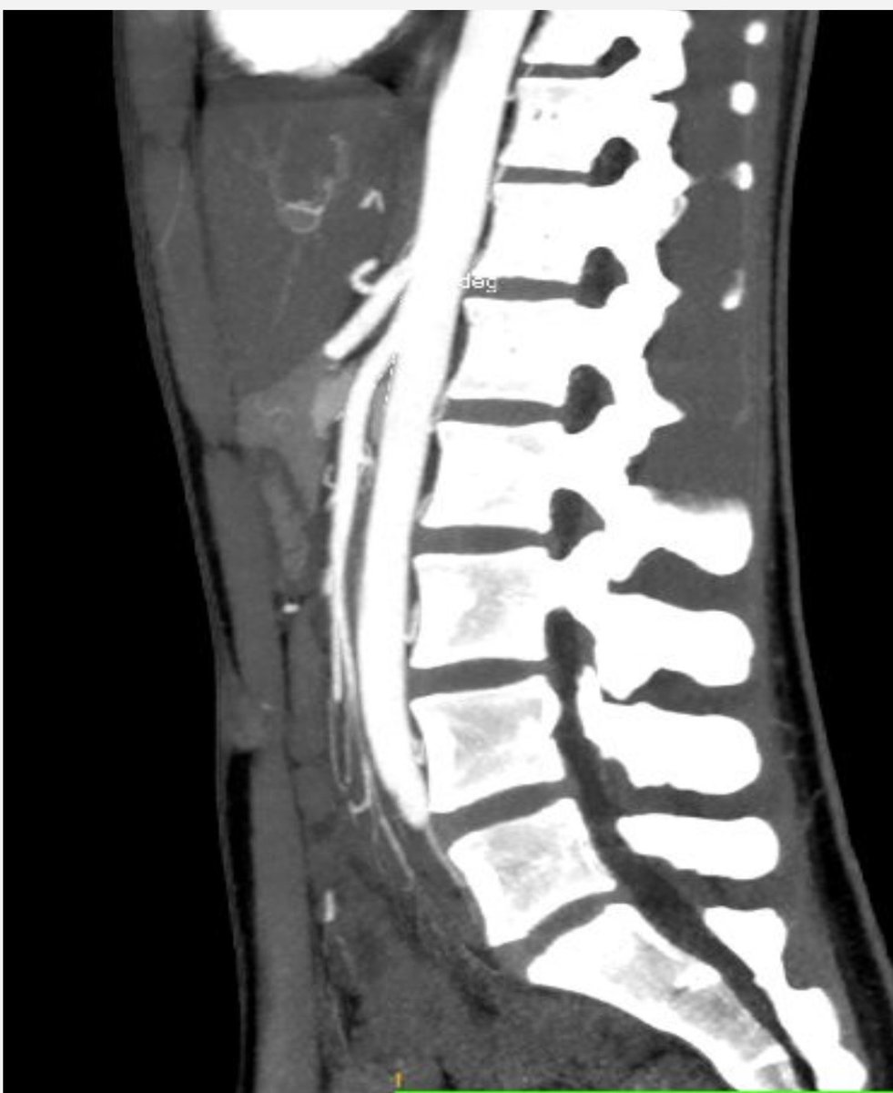 PucoIgnacio's tweet photo. Paciente de 18 años con antecedentes de anorexia nerviosa (IMC 15.6) con cuadro clínico de 1 año caracterizado por episodios intermitentes de epigastralgia punzante post prandial moderada a gran intensidad asociado a vomitos alimenticios. 

Diagnóstico ? https://t.co/5YvpoKTW2w