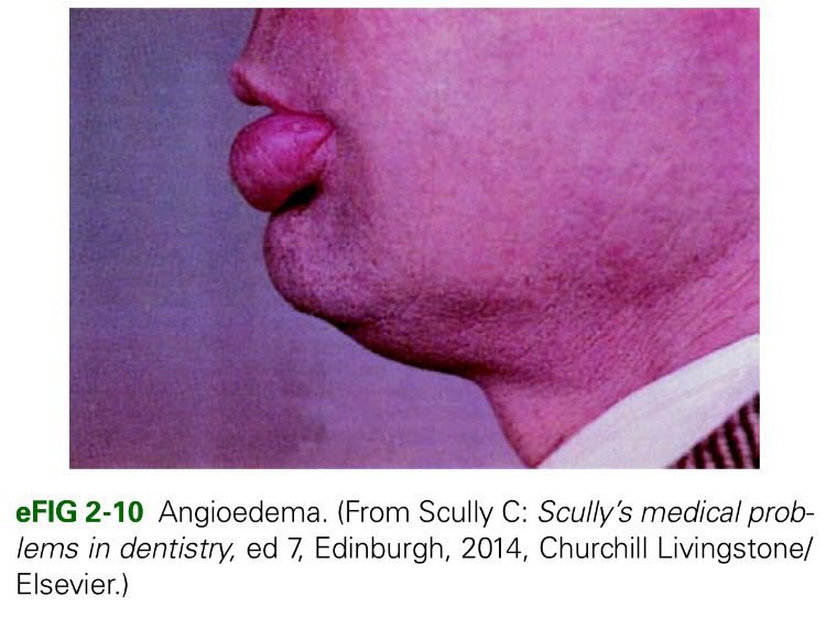 ⭕️ Angioedema : 💢 Although a result of the same mechanisms characteristic of hives, in which the edema is localized and limited to the superficial portion of the dermis, angioedema involves a wider and deeper portion of the dermis and subdermis, resulting in swelling over a…