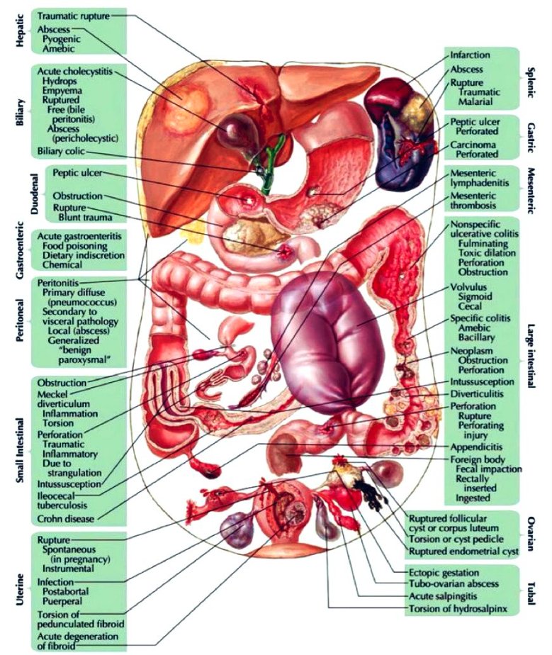 sepdigestiva's tweet image. Causes of acute abdomen 📌

#MedEd #MedTwitter #FOAMcc 
H/T Netter anatomy