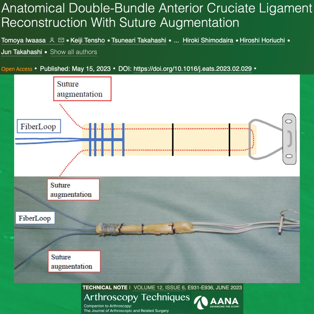 ArthroscopyJ's tweet photo. Check out this new technique for suture augmentation of a double bundle ACL reconstruction! #ACL #Augmentation #DoubleBundle https://t.co/B65CXRw3Zu https://t.co/3iGjEAAaGE