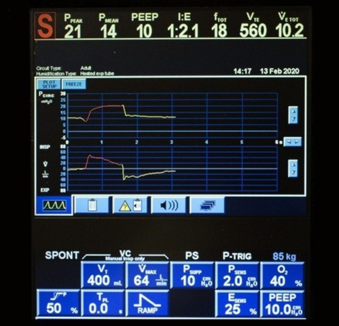 snwhealth's tweet image. It has been unclear whether mechanical power during ventilation is associated with adverse outcomes.

Link -
pubmed.ncbi.nlm.nih.gov/35475882/

#Anesthesiology #Anesthesiologist #Anesthesia #MedicalResearch #snwhealth #snwareresearch