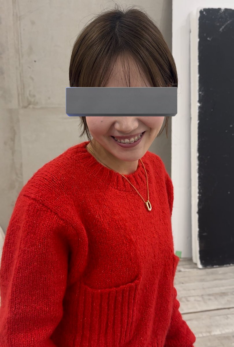 nozoomi4's tweet photo. お久しぶりです。なんとしても口元を引っ込めたいから抜歯矯正がいいと言う私に、骨格的に顎が長く見えてしまうから非抜歯でいこうと勧めてくれた先生らぶ。確かにいま顎伸びて見えるからこれ以上伸びてたらと思うとほんとに先生らぶ。 https://t.co/yqZPtfZJTa