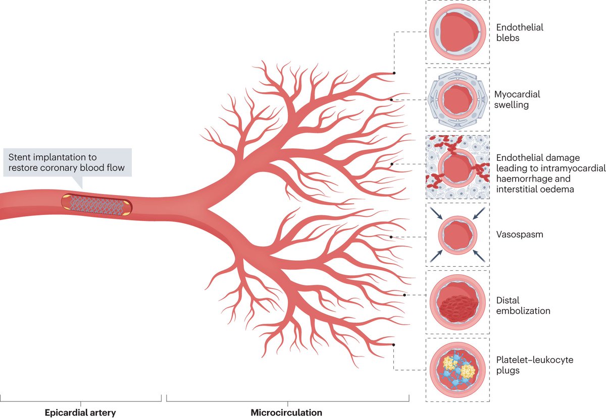 Nature Reviews Cardiology (@natrevcardiol) on Twitter photo Patients with coronary microvascular obstruction and dysfunction after myocardial infarction have a poor prognosis. In this new Review, <a href="/MattiaGalli10/">Mattia Galli</a> et al. discuss the mechanisms and possible treatment: rdcu.be/dr7K8 Patients with coronary microvascular obstruction and dysfunction after myocardial infarction have a poor prognosis. In this new Review, <a href="/MattiaGalli10/">Mattia Galli</a> et al. discuss the mechanisms and possible treatment: rdcu.be/dr7K8