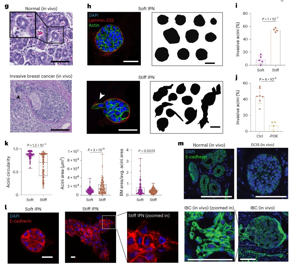 Let's break barriers in breast cancer research! A new study by @theChaudhurilab &West Lab @Stanford, @ShenoyLab @Penn and Hodgson Lab @EinsteinMed revealed how cells team up to break through tissue barriers. No invadopodia needed! @NatureMaterials doi.org/10.1038/s41563…