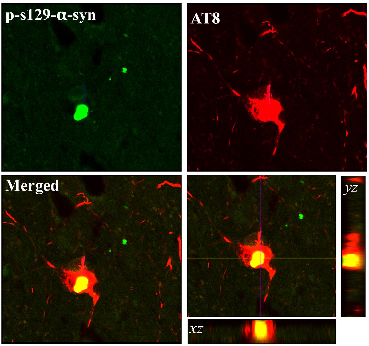 By comparing the brains of patients with mild motor deficits ± nigral synucleinopathy, and patients with PD, Chu et al. find that initiation of nigrostriatal DAergic neurodegeneration occurs independently of alpha-syn aggregation and can be tau mediated. tinyurl.com/mvmk6ej6