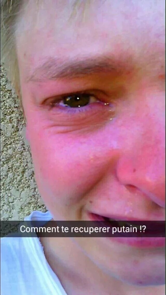 Davnoos's tweet photo. Quand le cathéter est à moitié arraché, que la perfusion ne passe plus et que le patient a des veines beaucoup trop compliquées a piquer https://t.co/aDyJ5ysEab