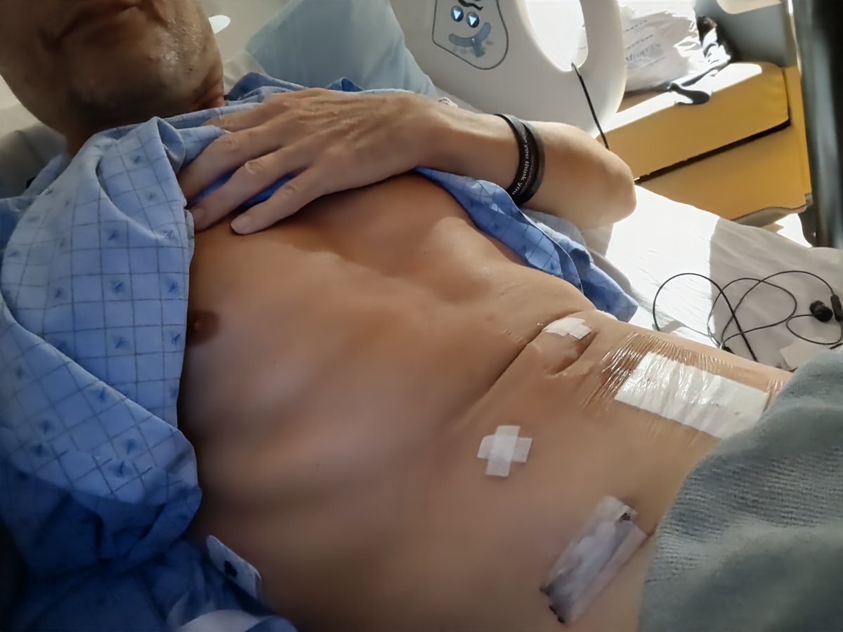 1111MAXMETAL's tweet photo. How I recovered from Major Surgery with Amino Acid Therapy https://t.co/9Fnf3DHFSX
#MotivationMonday #Fitnessmotivation #Martialarts #Mountainbiking #Positivevibes #workoutmotivation #BJJ #MMA #Lifeextension #Lifelessons #Gymlife #Beefliver @naturalstacks https://t.co/ke4g5v2cMu