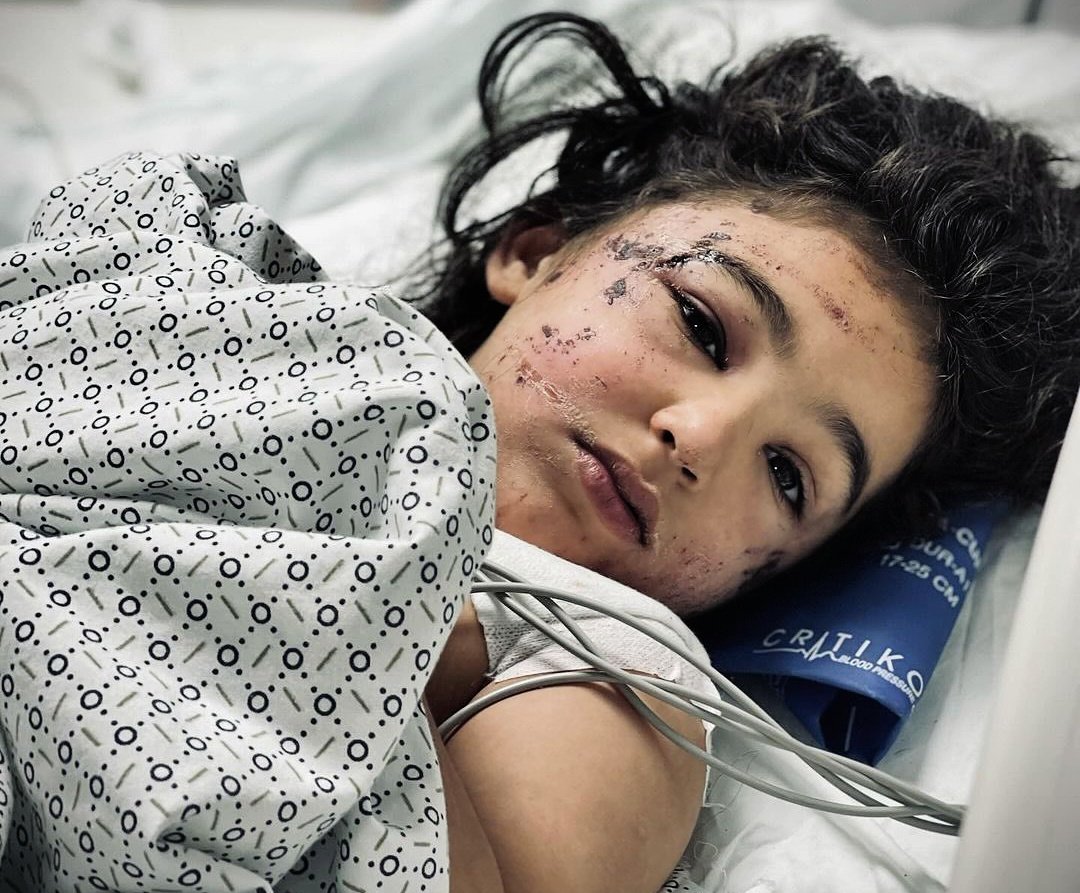 أصيبت الطفلة أسيل مسامح 7 أعوام أثناء الحرب .وتم بتر قدمها اليسري بالإضافة إلى إصابات عديدة فى جسدها وهي الآن تنتظر دورها لاستكمال علاجها في الخارج