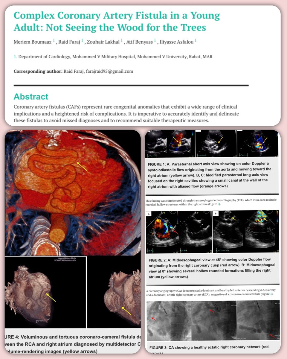 Complex Coronary Artery Fistula in a Young Adult: Not Seeing the Wood for the Trees

researchgate.net/publication/37…
