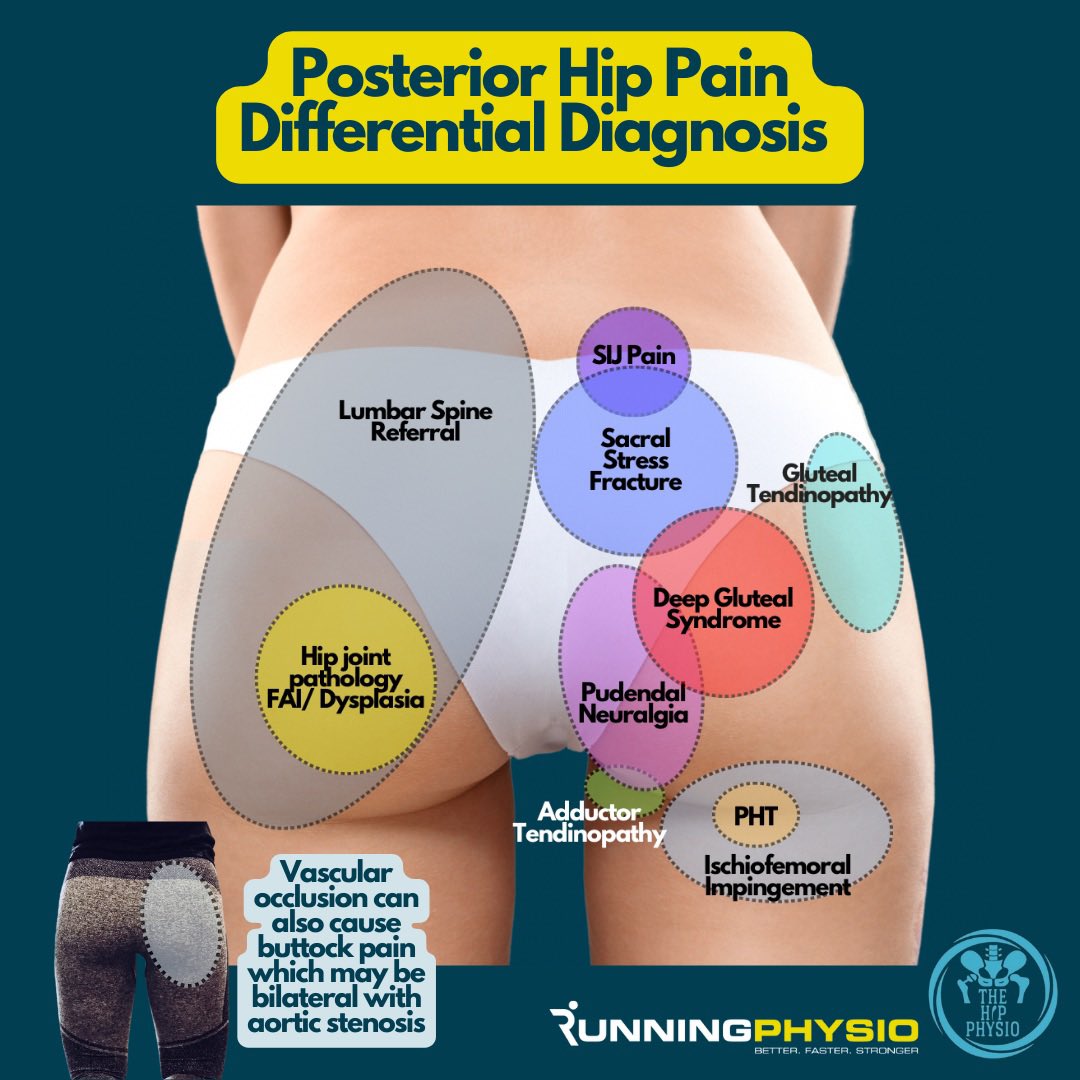 Hip Pain Location Diagram