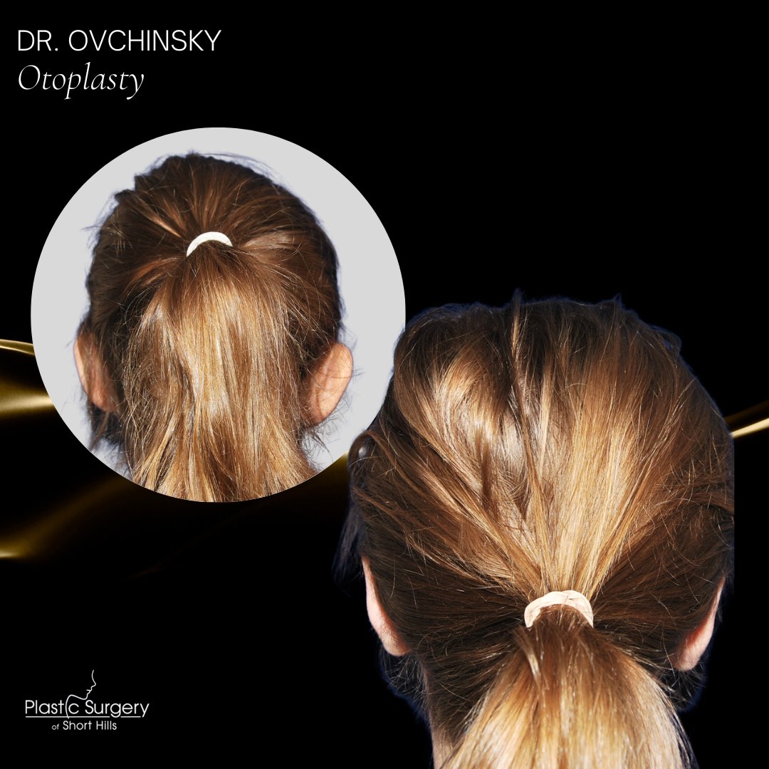 DrOvchinsky's tweet photo. Incredible Before &amp; After Otoplasty Results👂The most common reason patients undergo Otoplasty surgery is due to prominent ears sticking out from the head more than average. I am always here to help my patients of all ages feel confident and happy with their appearance! 🙌🏼 https://t.co/K18w5yKF8W
