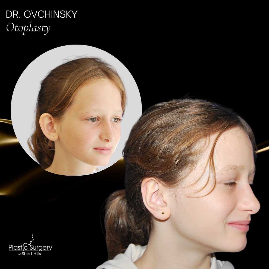 DrOvchinsky's tweet photo. Incredible Before &amp; After Otoplasty Results👂The most common reason patients undergo Otoplasty surgery is due to prominent ears sticking out from the head more than average. I am always here to help my patients of all ages feel confident and happy with their appearance! 🙌🏼 https://t.co/K18w5yKF8W
