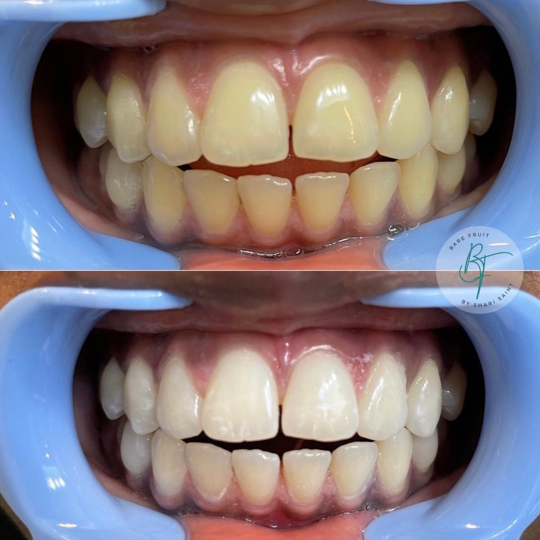 BareFruitSugar's tweet photo. Give yourself the gift of confidence this Holiday Season with our Black Friday sale! Buy 2 Teeth Whitening for only $200 and light up any room with your dazzling smile�� #BlackFriday #teethwhitening #longisland https://t.co/2nlDd9DSMO
