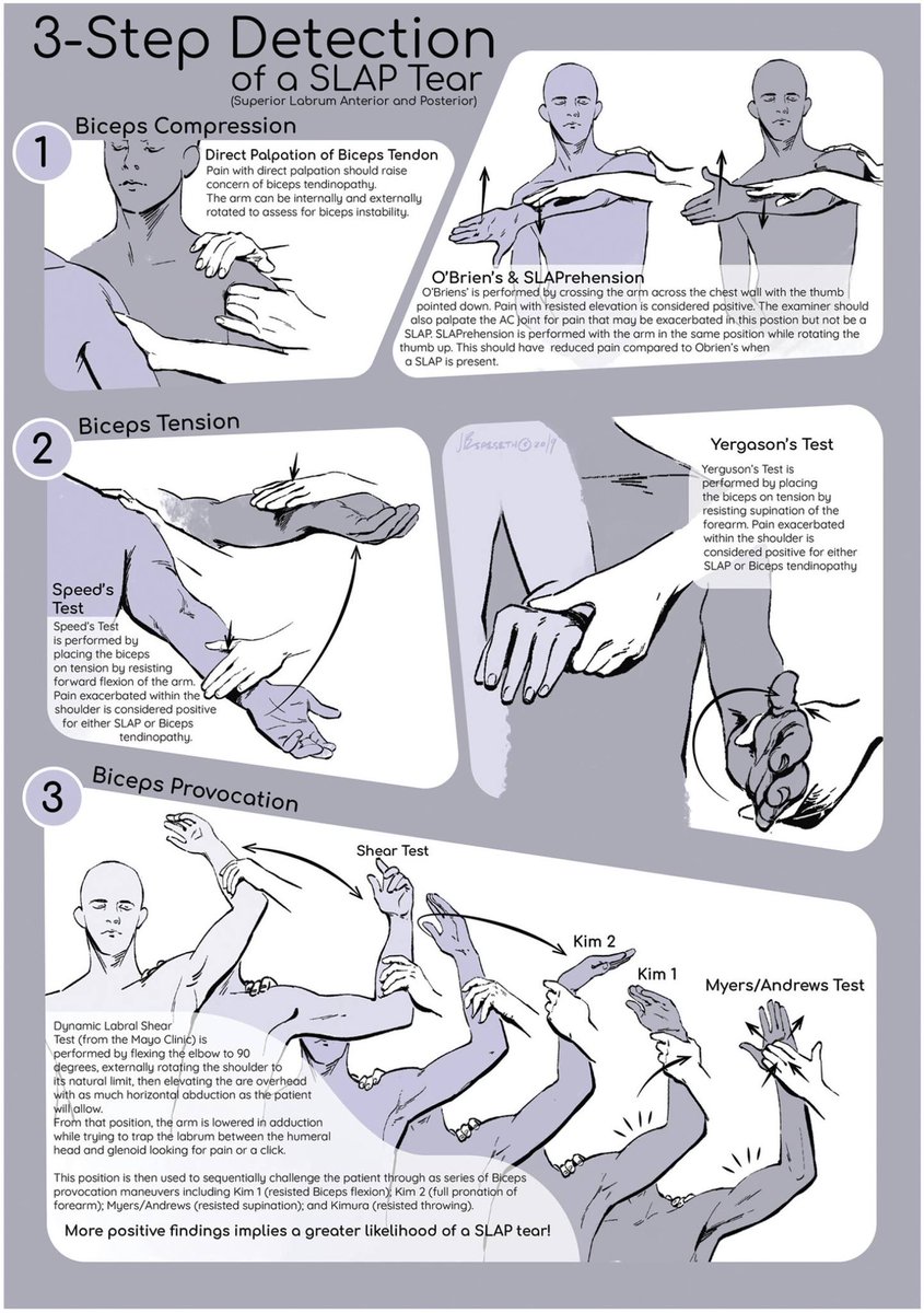 AOSSM (@aossm1972) on Twitter photo 🔍@AJSM_SportsMed explores the latest research on diagnosing SLAP lesions with physical examination maneuvers. This systematic review and meta-analysis, conducted <a href="/thisisUIC/">University of Illinois Chicago</a>, reveal key insights for #orthopaedic practitioners. Read more: ow.ly/NqUa50Q7cSU #SportsMedicine 🔍@AJSM_SportsMed explores the latest research on diagnosing SLAP lesions with physical examination maneuvers. This systematic review and meta-analysis, conducted <a href="/thisisUIC/">University of Illinois Chicago</a>, reveal key insights for #orthopaedic practitioners. Read more: ow.ly/NqUa50Q7cSU #SportsMedicine