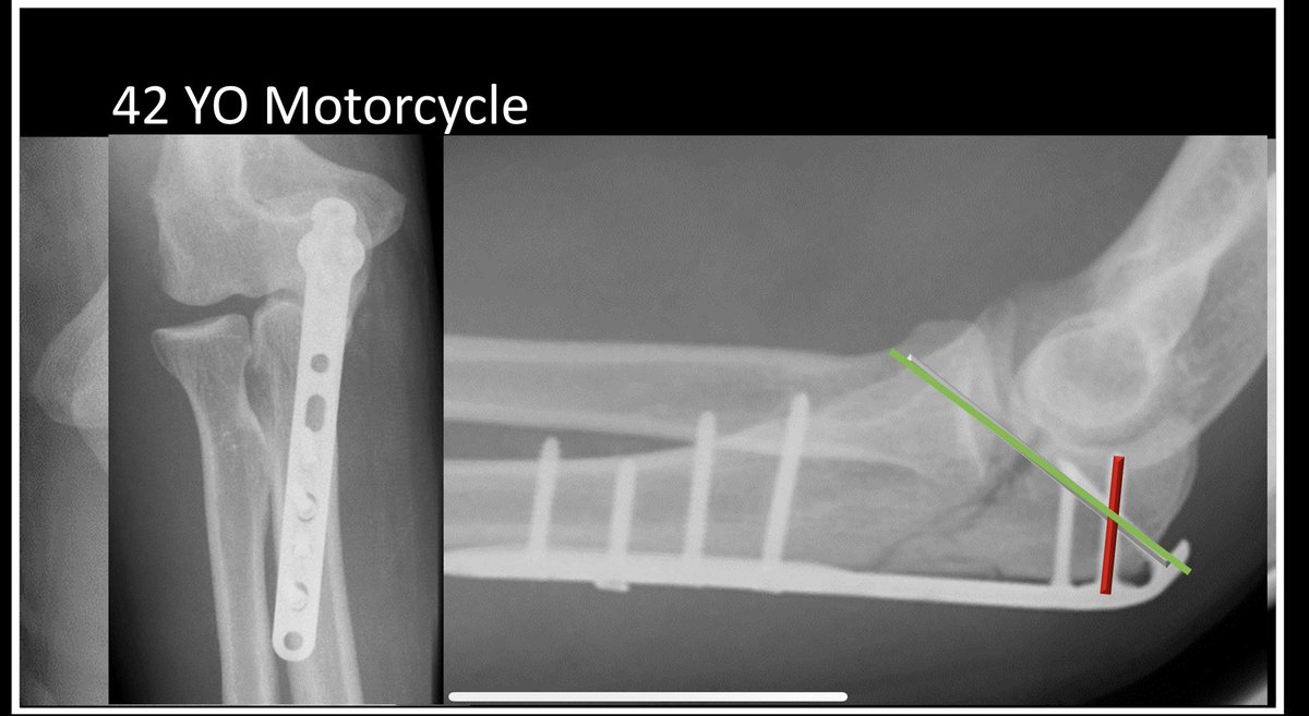 Gnomelover1970's tweet photo. Again I’m an outlier.
I would change the red screw.
Although would look pleasing to the eye and biomechanically stronger to make green screw longer.
It’s not needed, no intermediate fragment.
Making it longer holds distal fragment and coronoid.
Hold on prox. fragment good.
🧵 1/2 https://t.co/WJsJaqQ6WH