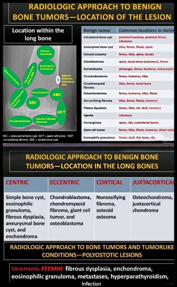 Primary benign bone tumors are more common than malignancies in CHILDREN & ADOLESCENTS. ✔️Patient age & lesion location are two critical factors when evaluating a bone tumor. slideplayer.com/amp/15160494/ ✔️Radiography is the mainstay.. ✔️CT & MRI, help to evaluate extent of lesions