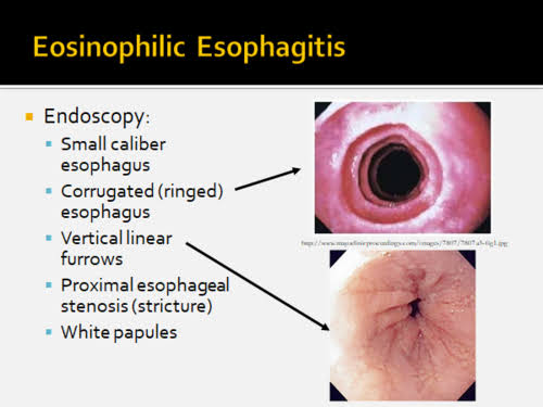 Endoscopic Aspects of Eosinophilic Esophagitis: From Diagnosis to Therapy