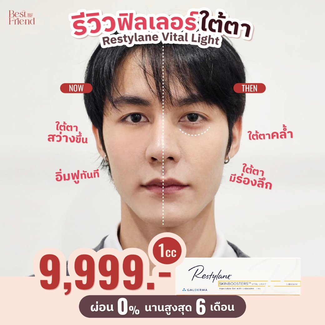 #รีวิวจากลูกค้าจริง Filler Restylane บริเวณใต้ตา เคสนี้ใช้รุ่น Vital Light เพิ่มความสว่างให้ใต้ตา✨️ จากภาพจะเห็นได้ว่า Then คนไข้มีใต้ตาที่คล้ำและมีร่องลึก หลังจากฉีดเสร็จทันที Now ใต้ตาสว่างขึ้น และดูอิ่มฟูขึ้น💖

🔥1 cc 9,999.-🔥
ผ่อน 0% นานสูงสุด 6 เดือน