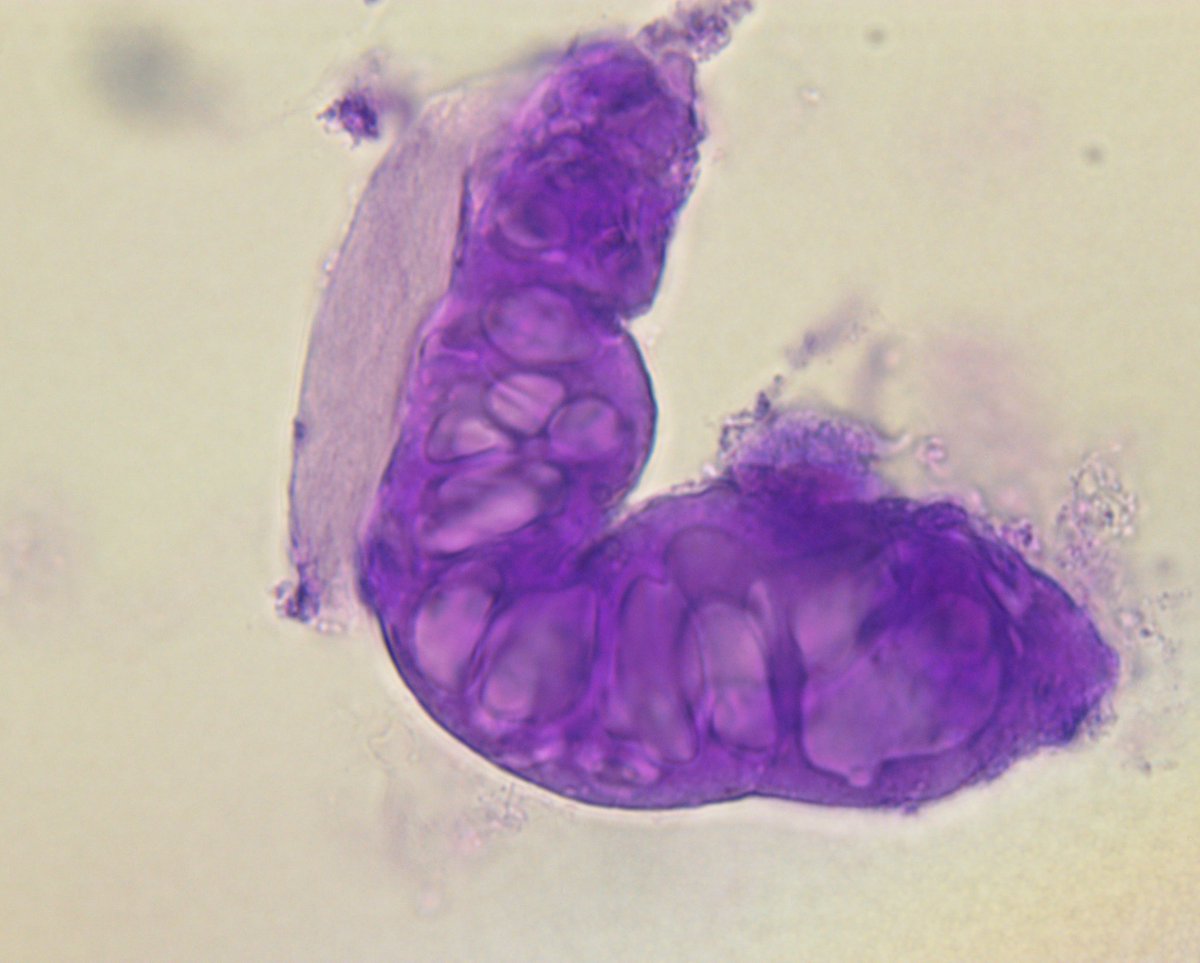 SwethaKanduriMD's tweet photo. 🔔 #UrinaryCasts

❓RBC cast or a Lipid cast

✅Turns out to be a Vacuolated cast

📝 Vacuolated casts: cast containing vesicles💧of various sizes and shapes

📝RBC casts: contain RBC that are uniformly round 

📝Lipid casts: spherical droplets, smaller in size and polarizable https://t.co/GaVcaFnbYq