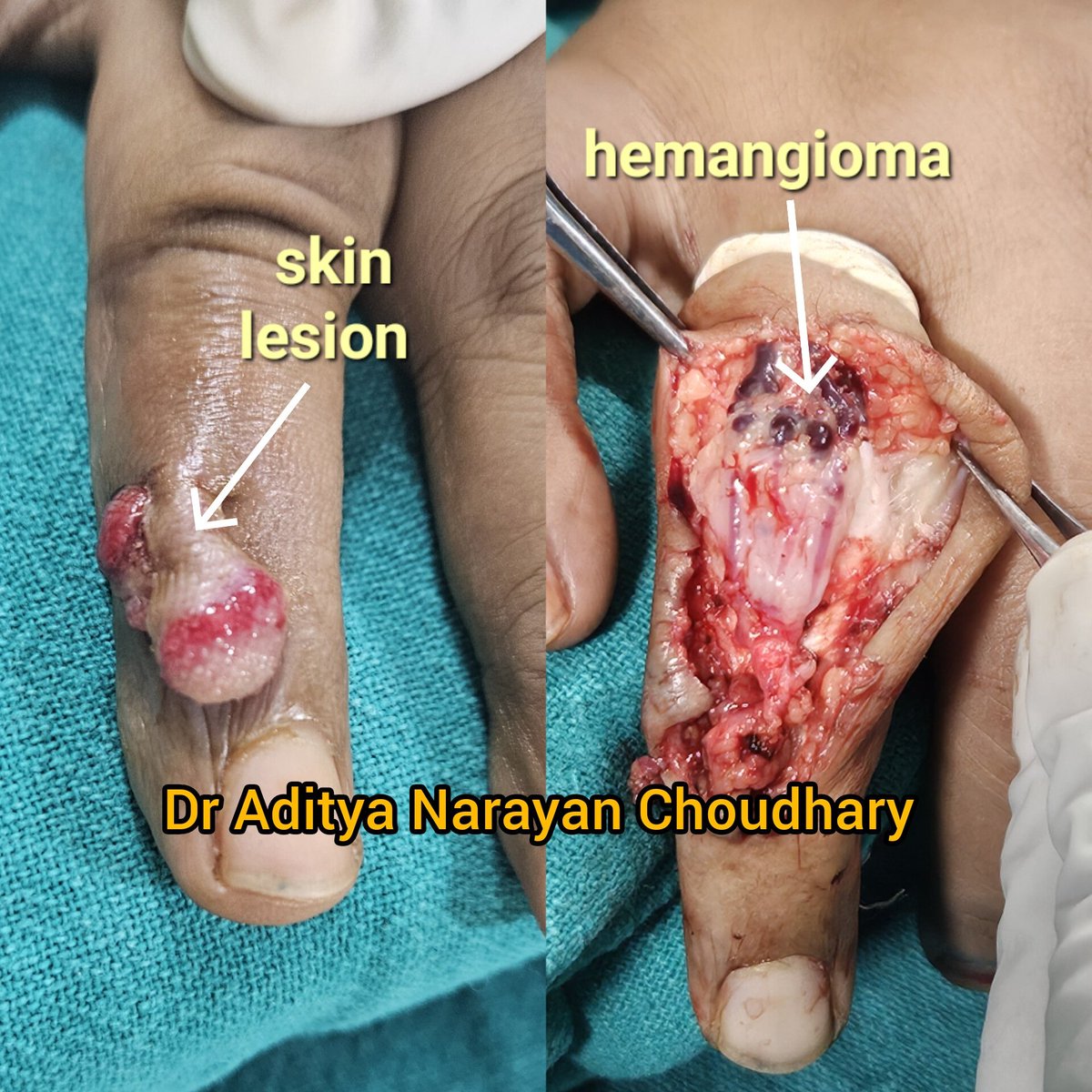 adi5989's tweet image. Performed excision of a hemangioma on the dorsal aspect of a finger – what seemed like a simple exophytic lesion held a world of intricacy beneath. Grateful for the opportunity to enhance both form and function. Cheers🤗
#PlasticSurgery #HemangiomaExcision #PrecisionInPractice