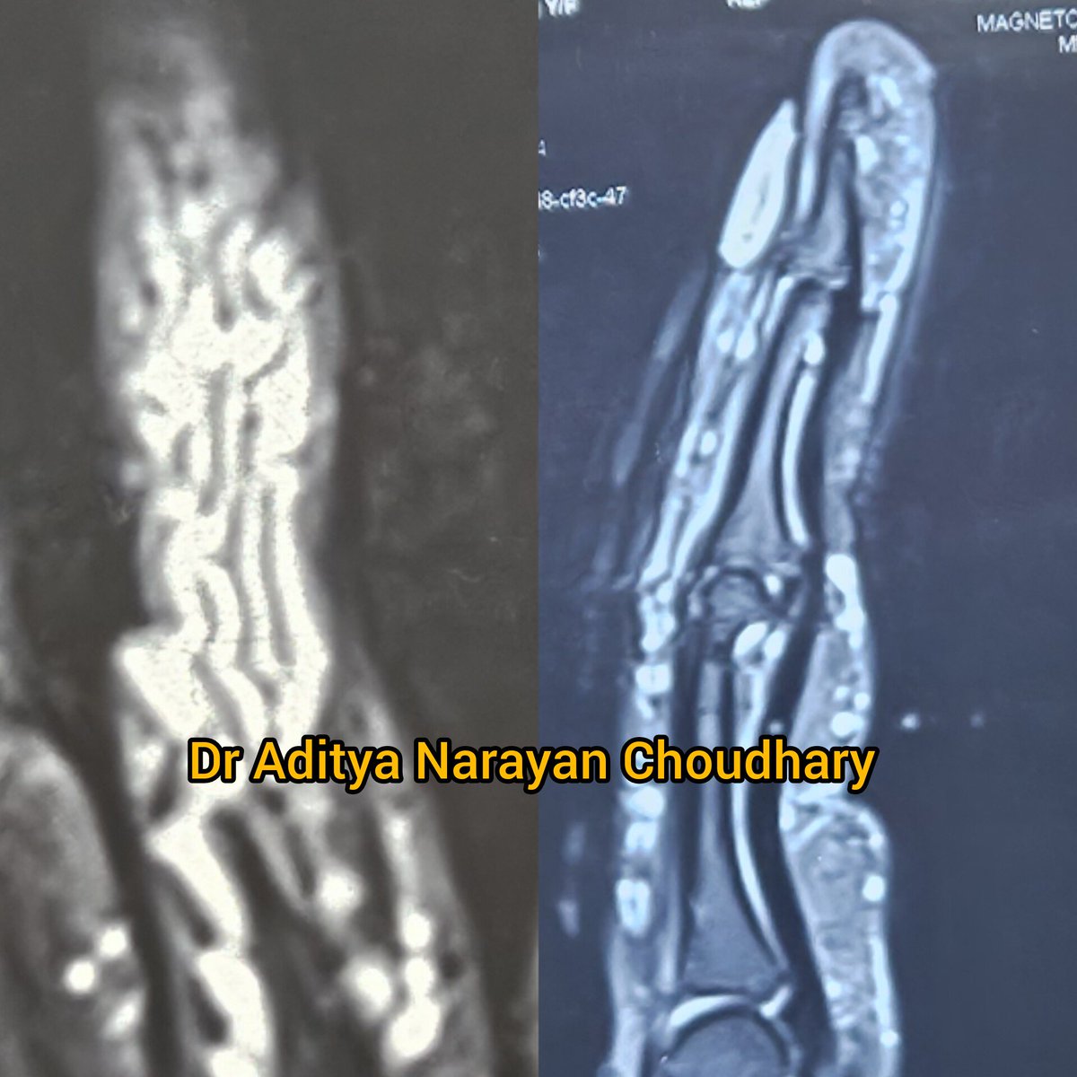 adi5989's tweet image. Performed excision of a hemangioma on the dorsal aspect of a finger – what seemed like a simple exophytic lesion held a world of intricacy beneath. Grateful for the opportunity to enhance both form and function. Cheers🤗
#PlasticSurgery #HemangiomaExcision #PrecisionInPractice