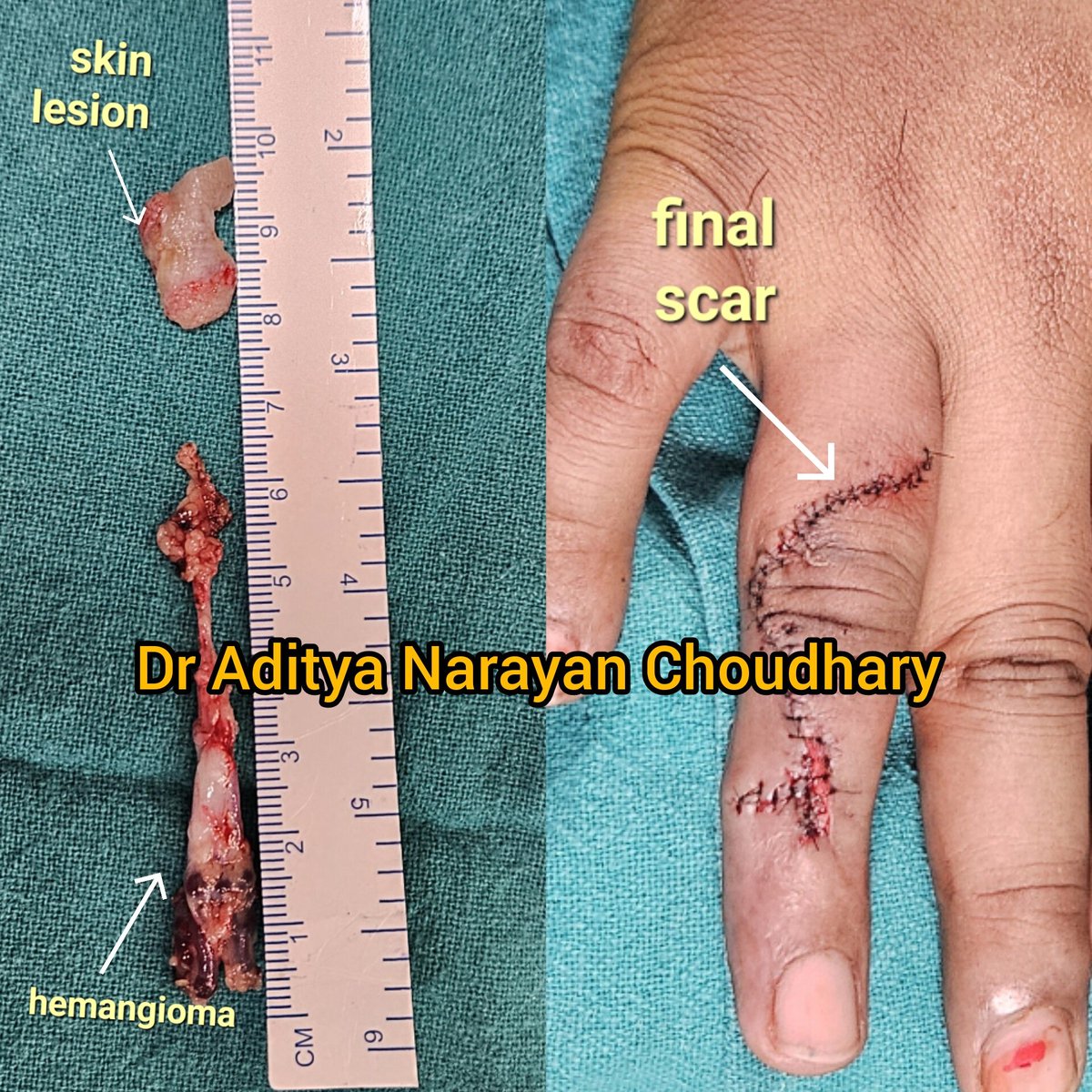 adi5989's tweet image. Performed excision of a hemangioma on the dorsal aspect of a finger – what seemed like a simple exophytic lesion held a world of intricacy beneath. Grateful for the opportunity to enhance both form and function. Cheers🤗
#PlasticSurgery #HemangiomaExcision #PrecisionInPractice