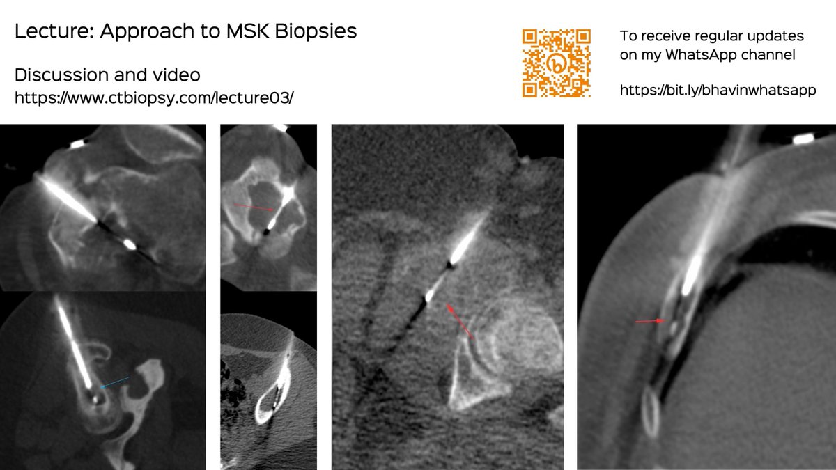 bhavinj's tweet photo. Lecture: Approach to MSK Biopsies - Bone Biopsies
Discussion - how to biopsy bone lesions
https://t.co/ijAzgwm462
#ctbiopsy #irrad #bonebiopsy #spinebiopsy #lecture https://t.co/ZNWt5OT75l